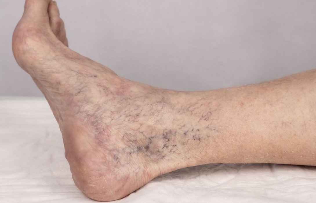 รวมวิธีเลือกคลินิกรักษาเส้นเลือดขอด ให้เหมาะกับอาการ ปลอดภัย เห็นผลจริง