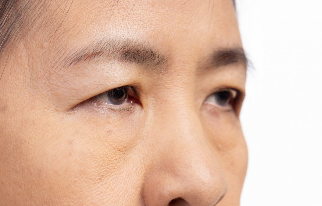 เปลือกตาไม่เท่ากัน มีวิธีแก้ไขอย่างไรบ้าง