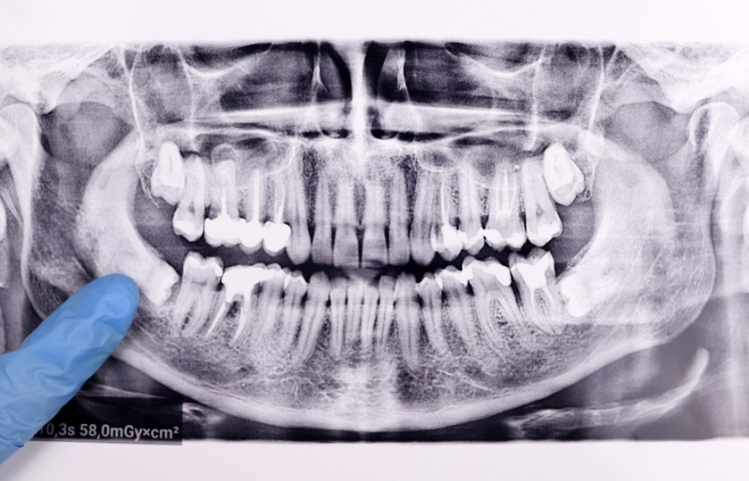 ปวดฟันซี่ในสุด? เช็กสัญญาณต้องผ่าฟันคุด พร้อมวิธีดูแลให้หายไว
